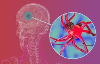 Para peneliti memblokir protein kunci yang membantu penyakit Parkinson menyebar di otak