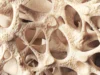 Osteopenia diam-diam melemahkan tulang jutaan orang