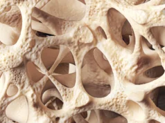 Osteopenia diam-diam melemahkan tulang jutaan orang