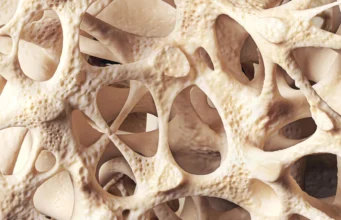 Osteopenia diam-diam melemahkan tulang jutaan orang