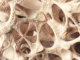 Osteopenia diam-diam melemahkan tulang jutaan orang