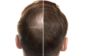 Pengobatan Tiongkok kuno dapat mengubah pengobatan rambut rontok