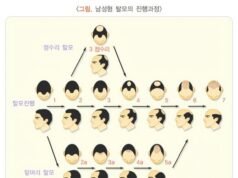 Seberapa botakkah cukup botak? Kaum muda Korea mengikuti dengan cermat perdebatan tentang asuransi rambut rontok