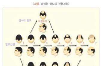 Seberapa botakkah cukup botak? Kaum muda Korea mengikuti dengan cermat perdebatan tentang asuransi rambut rontok
