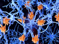 Sel-sel otak yang penuh lemak ini bisa memperburuk multiple sclerosis