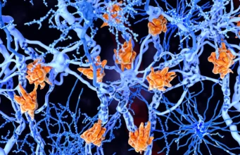 Sel-sel otak yang penuh lemak ini bisa memperburuk multiple sclerosis