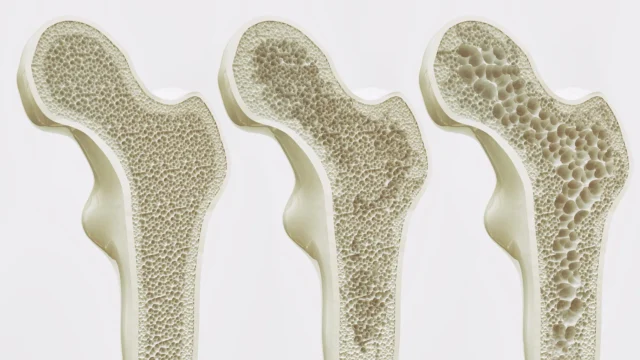 Semaglutide (Ozempic) dikaitkan dengan lebih sedikit patah tulang meskipun penurunan