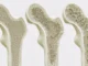 Semaglutide (Ozempic) dikaitkan dengan lebih sedikit patah tulang meskipun penurunan berat badan lebih besar