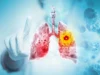 Studi besar menemukan vaping kemungkinan besar menyebabkan kanker paru-paru dan mulut