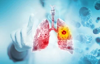 Studi besar menemukan vaping kemungkinan besar menyebabkan kanker paru-paru dan mulut