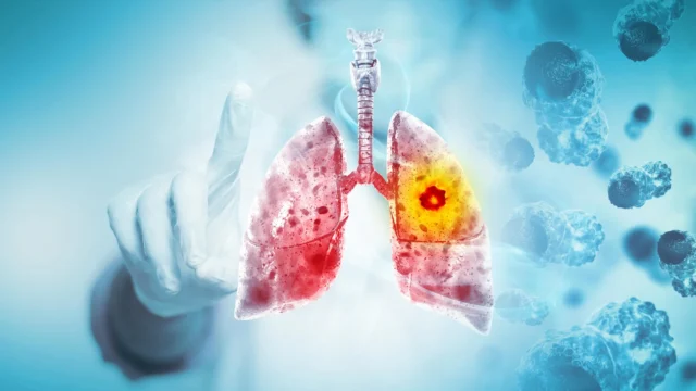 Studi besar menemukan vaping kemungkinan besar menyebabkan kanker paru-paru dan