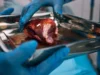 Hampir separuh pasien transplantasi ginjal bahkan tidak pernah memulainya