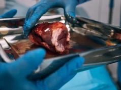 Hampir separuh pasien transplantasi ginjal bahkan tidak pernah memulainya