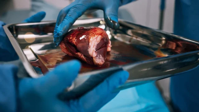 Hampir separuh pasien transplantasi ginjal bahkan tidak pernah memulainya