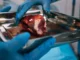 Hampir separuh pasien transplantasi ginjal bahkan tidak pernah memulainya