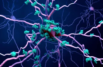 Para ilmuwan mungkin akhirnya menemukan bagaimana penyakit Alzheimer membunuh sel-sel otak