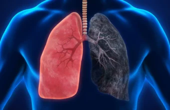 Penggunaan ganja dalam jumlah besar dapat meningkatkan risiko kanker, para peneliti memperingatkan